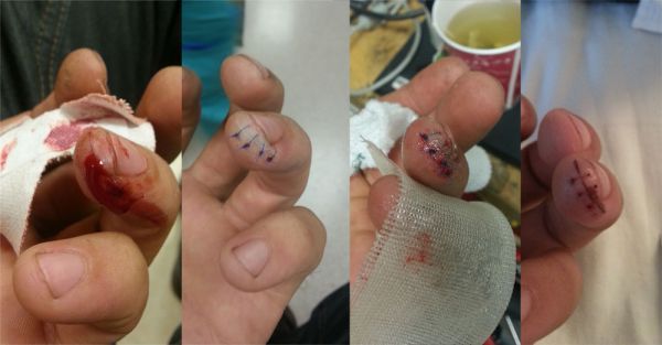 HandInjury